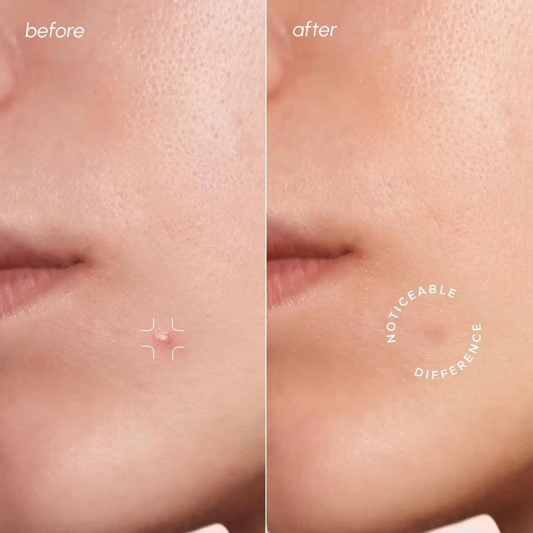 Invisible Pimple & Acne Patches Maree