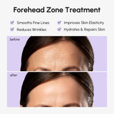 Anti-Wrinkle Forehead Patches Maree
