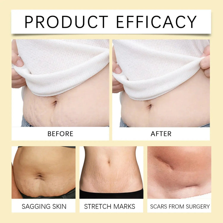Stretch Mark Lightening Essential Oil Skin Care Cream for Pregnant Women Moisturizing Lifting Firming Skin Slimming Oil 100ml Roksy